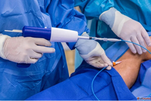 Innovative VenaSeal Technique for Pain-Free Vein Treatment