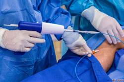 Innovative VenaSeal Technique for Pain-Free Vein Treatment