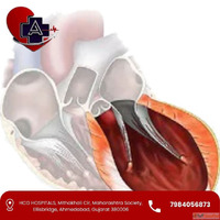 Dr. Abhishek Parmar - Left Ventricular Aneurysm Treatment in...