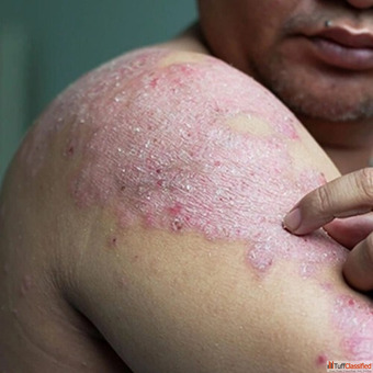 Psoriasis Eczema Skin Allergy Treatment Doctor in Meerut