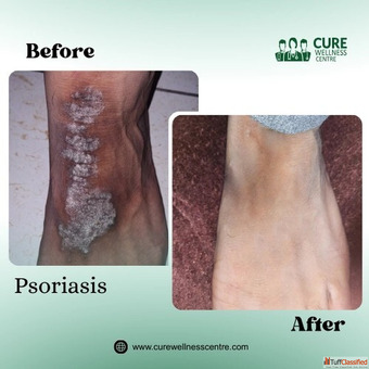 Psoriasis Eczema Skin Allergy Treatment Doctor in Meerut