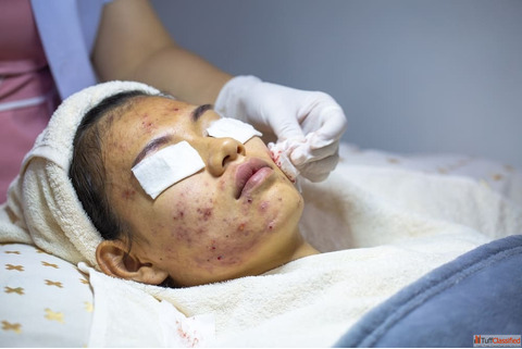 Advanced Acne Scar Treatment in Dubai for Clear Healthy Skin