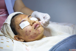Advanced Acne Scar Treatment in Dubai for Clear Healthy Skin