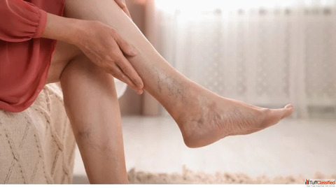 Expert Solutions for Deep Vein Thrombosis Treatment