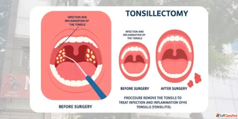 Best ENT Specialist Hyderabad Tonsil Surgery Adenoidectomy Treatment