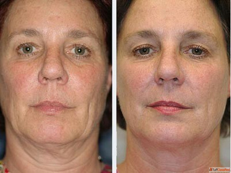 Best Anti Ageing Treatment in Chandigarh for Youthful Radiant Skin