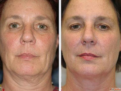 Best Anti Ageing Treatment in Chandigarh for Youthful Radian...