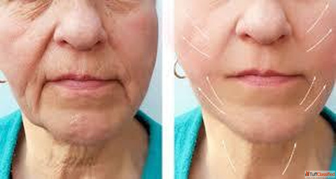 Best Anti Ageing Treatment in Chandigarh for Youthful Radiant Skin