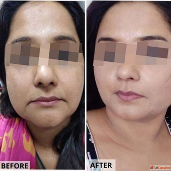 Best Anti Ageing Treatment in Chandigarh for Youthful Radiant Skin