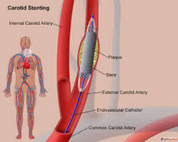 Advanced Carotid Angioplasty and Stenting Procedure