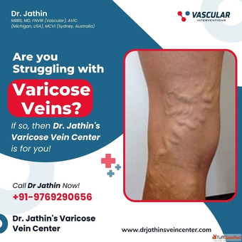Modern Vein Care for Lasting Relief Better Health