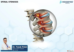 Spinal Stenosis Treatment Doctor in Ahmedabad Expert Spine C...