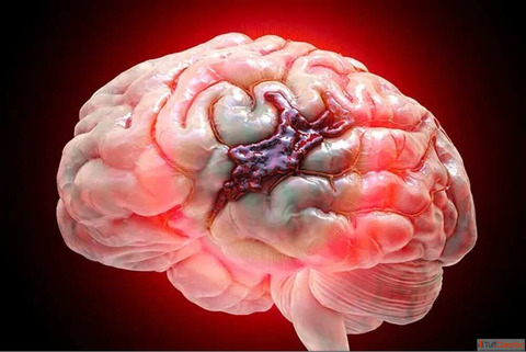 Brain Hemorrhage Treatment Cost in India - Affordable Care IR Facilities