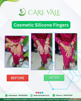 Best Artificial Leg in Hyderabad CareVale Prosthetics