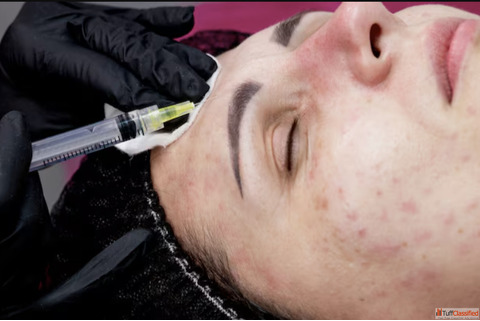 What is the Most Effective Acne Remover