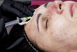 What is the Most Effective Acne Remover