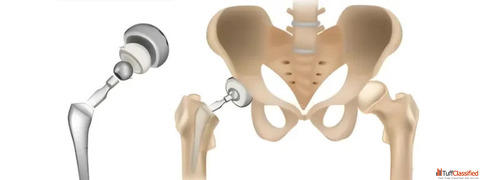 Expert Hip Replacement Treatment in Ahmedabad