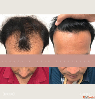 Best Hair Transplant in Indore Advanced FUE FUT PRP Hair Restoration Solutions
