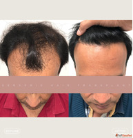 Best Hair Transplant in Indore Advanced FUE FUT PRP Hair Res...