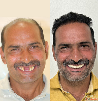 Best Hair Transplant in Indore Advanced FUE FUT PRP Hair Restoration Solutions