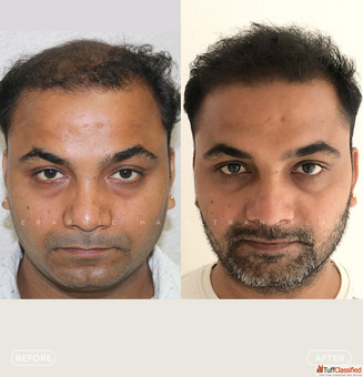 Best Hair Transplant in Indore Advanced FUE FUT PRP Hair Restoration Solutions