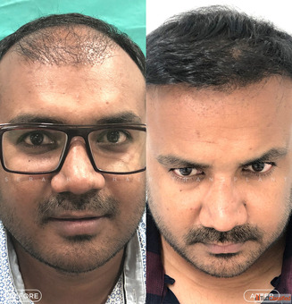 Best Hair Transplant in Indore Advanced FUE FUT PRP Hair Restoration Solutions