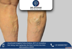 Gentle Modern Varicose Veins Treatment in India by Dr. Dhara...