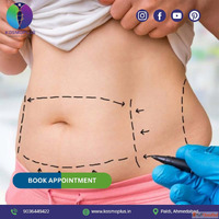 Remove Extra Belly Fat with Tummy Tuck Surgery in Ahmedabad