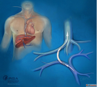 TIPS Procedure for Portal Hypertension