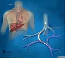 TIPS Procedure for Portal Hypertension