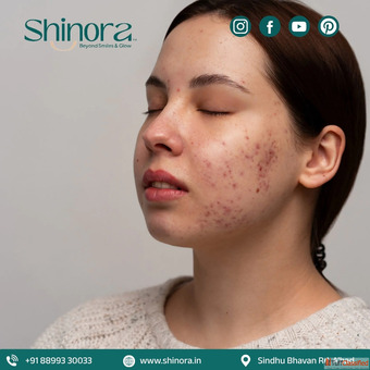 Shinora Clinic - Acne Scar Treatment in Ahmedabad for Advanced Skin Solutions