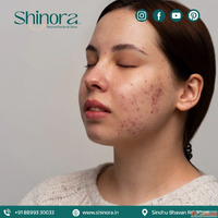 Shinora Clinic - Acne Scar Treatment in Ahmedabad for Advanc...
