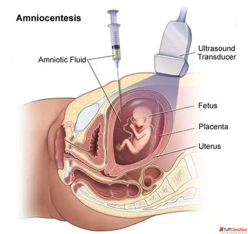 Budget Amniocentesis test Fetal India