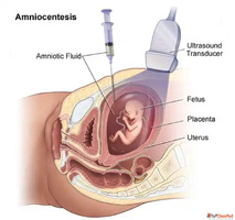Budget Amniocentesis test Fetal India