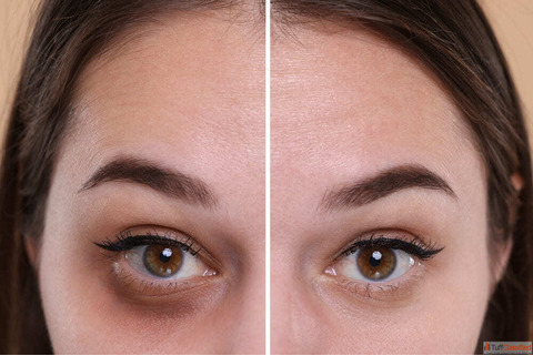Advanced Dark Circle Treatment in Dubai for Brighter Youthful Eyes