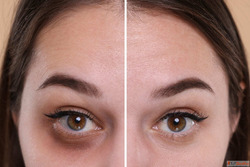 Advanced Dark Circle Treatment in Dubai for Brighter Youthfu...