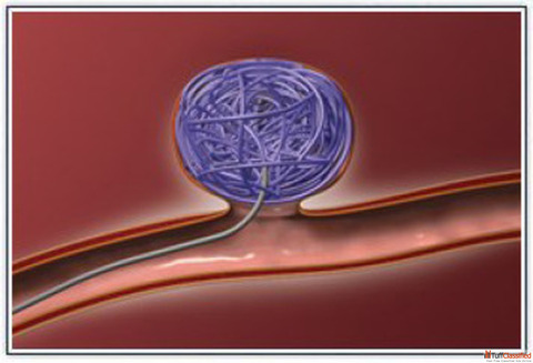 Trusted Coil Embolization Experts in India