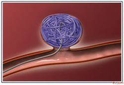 Trusted Coil Embolization Experts in India