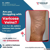 Expert Varicose Vein Care with Safe Procedures