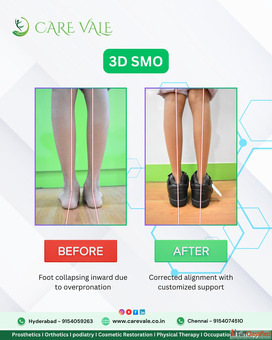 Best Artificial Leg in Hyderabad CareVale Prosthetics