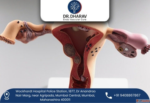 Safe and Effective Uterine Fibroids Treatment by Dr. Dharav Kheradia