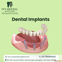 Affordable Dental Implants in Vidyaranyapura Bangalore Ivy D...