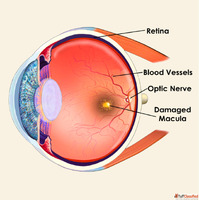 Age Related Macular Degeneration AMD Types Causes Diagnosis ...