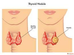 Non-Surgical Thyroid Nodule Treatment Benefits