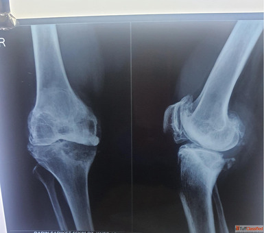 Fracture Treatment in Kolkata When to Act and What to Expect