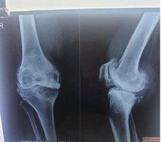 Fracture Treatment in Kolkata When to Act and What to Expect