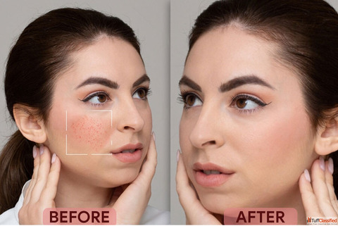 Best Aesthetic Clinic in Chandigarh for Botox Laser Hair Removal