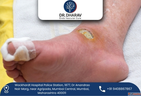 Protect Your Feet with Advanced Diabetic Foot Treatment