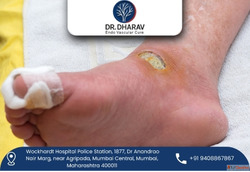 Protect Your Feet with Advanced Diabetic Foot Treatment