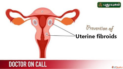 Uterine Fibroids Prevention Symptoms Minimally Invasive Care